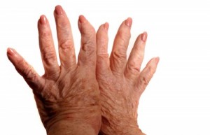 picture of hands with arthritis