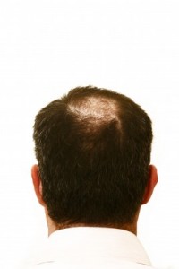 picture of hair loss 