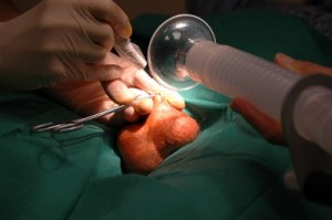 picture of vasectomy-04