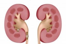 picture of kidney stones